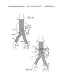 Platelet Gel for Treatment of Aneurysms diagram and image