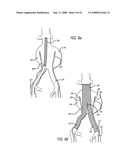 Platelet Gel for Treatment of Aneurysms diagram and image