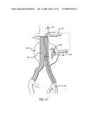 Platelet Gel for Treatment of Aneurysms diagram and image