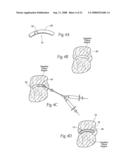 Devices, systems, and methods to fixate tissue within the regions of body, such as the pharyngeal conduit diagram and image