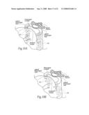 Devices, systems, and methods to fixate tissue within the regions of body, such as the pharyngeal conduit diagram and image