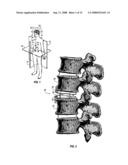 SURGICAL IMPLANT SECURED BY PEGS AND ASSOCIATED METHODS diagram and image