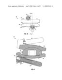 SURGICAL IMPLANT SECURED BY PEGS AND ASSOCIATED METHODS diagram and image