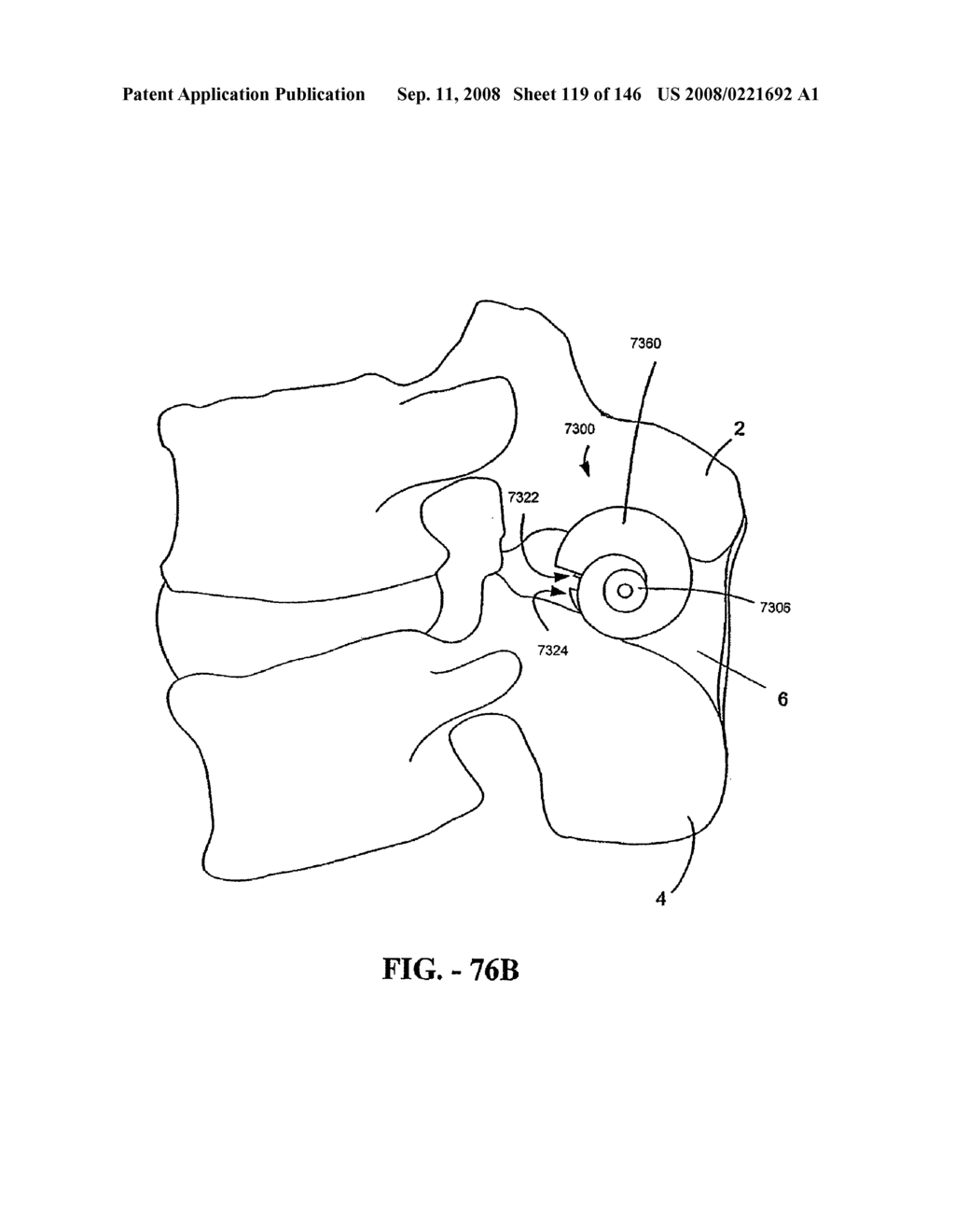 INTERSPINOUS PROCESS IMPLANTS AND METHODS OF USE - diagram, schematic, and image 121