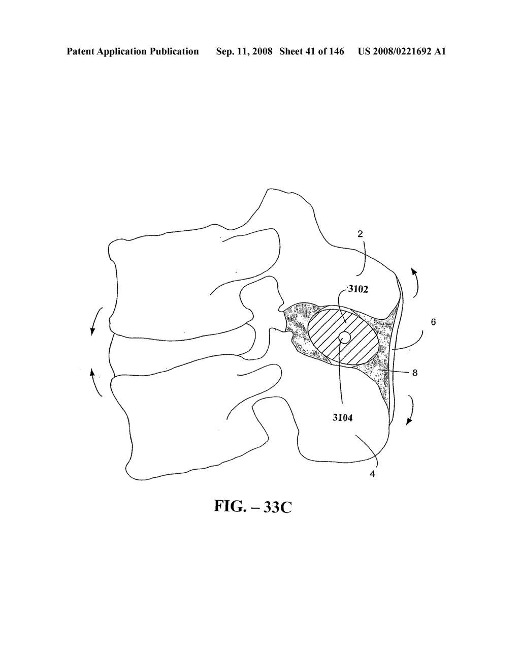 INTERSPINOUS PROCESS IMPLANTS AND METHODS OF USE - diagram, schematic, and image 43