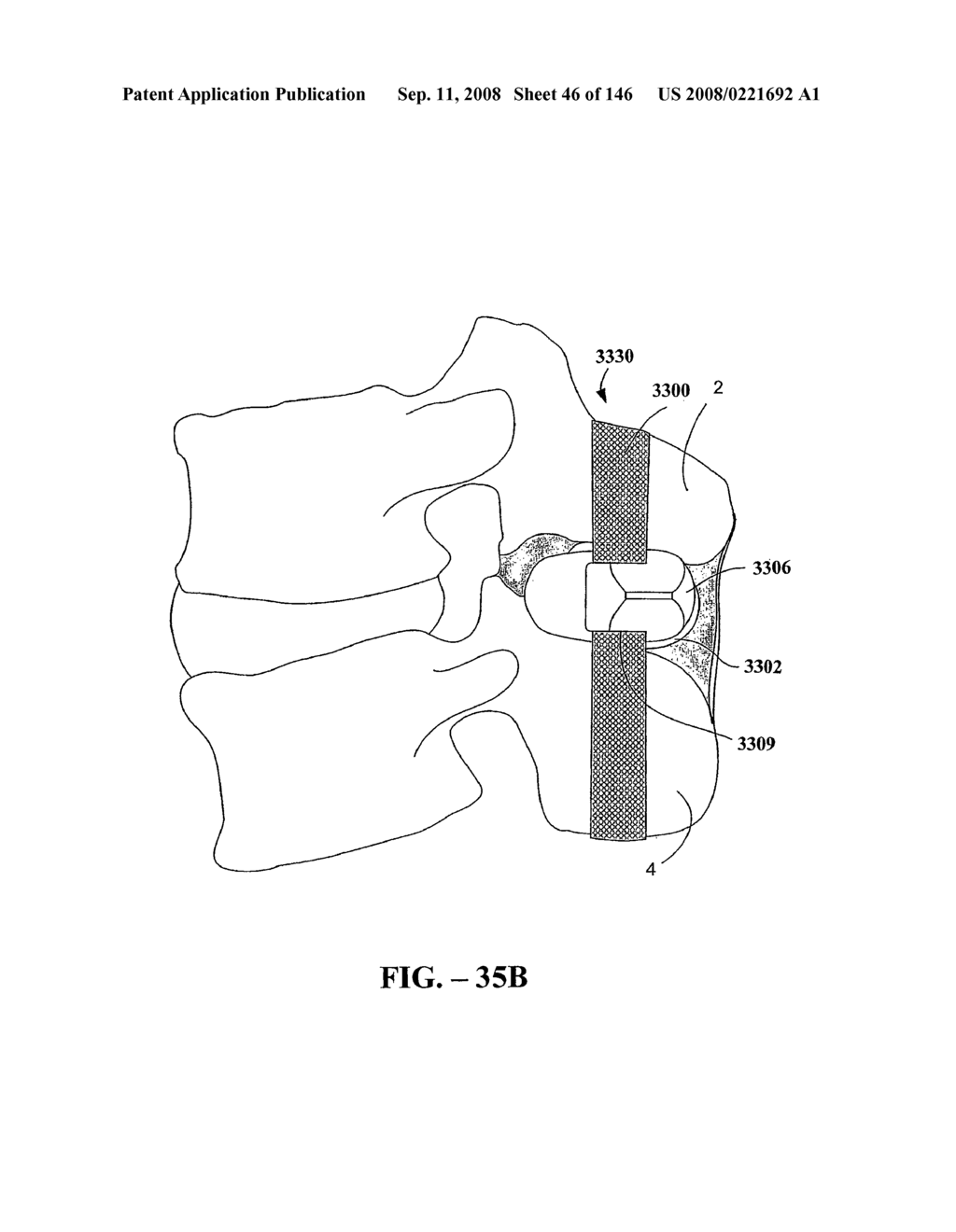 INTERSPINOUS PROCESS IMPLANTS AND METHODS OF USE - diagram, schematic, and image 48