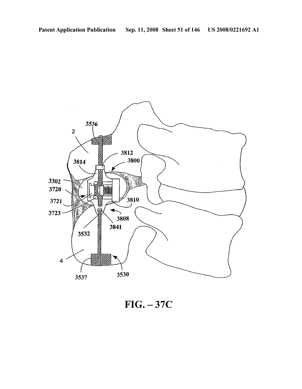 INTERSPINOUS PROCESS IMPLANTS AND METHODS OF USE - diagram, schematic, and image 53