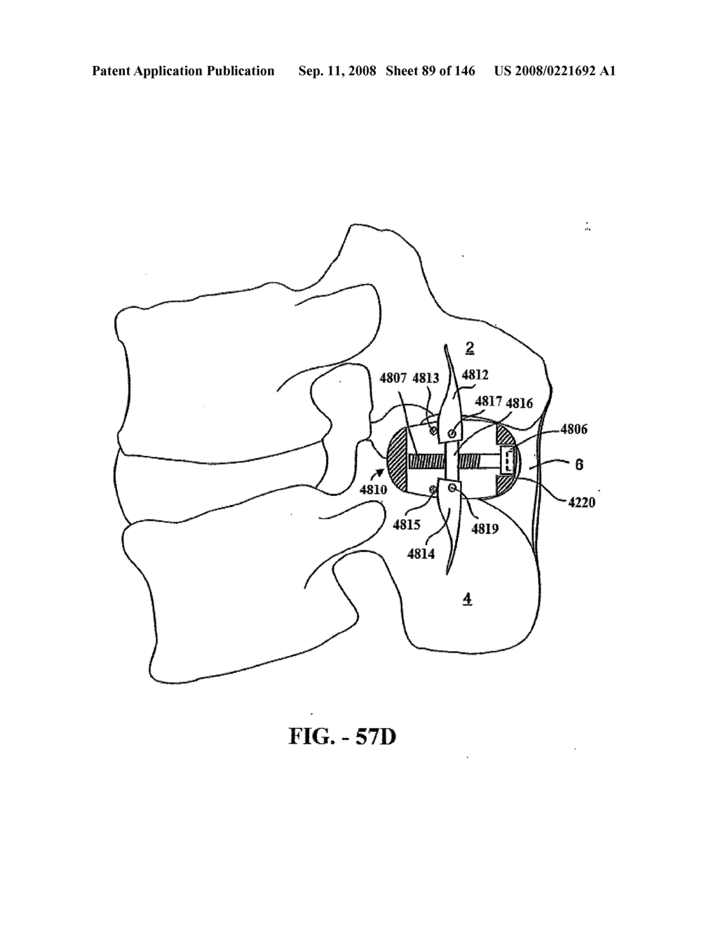 INTERSPINOUS PROCESS IMPLANTS AND METHODS OF USE - diagram, schematic, and image 91