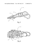 Hemi-implant for first metatarsophalangeal joint diagram and image
