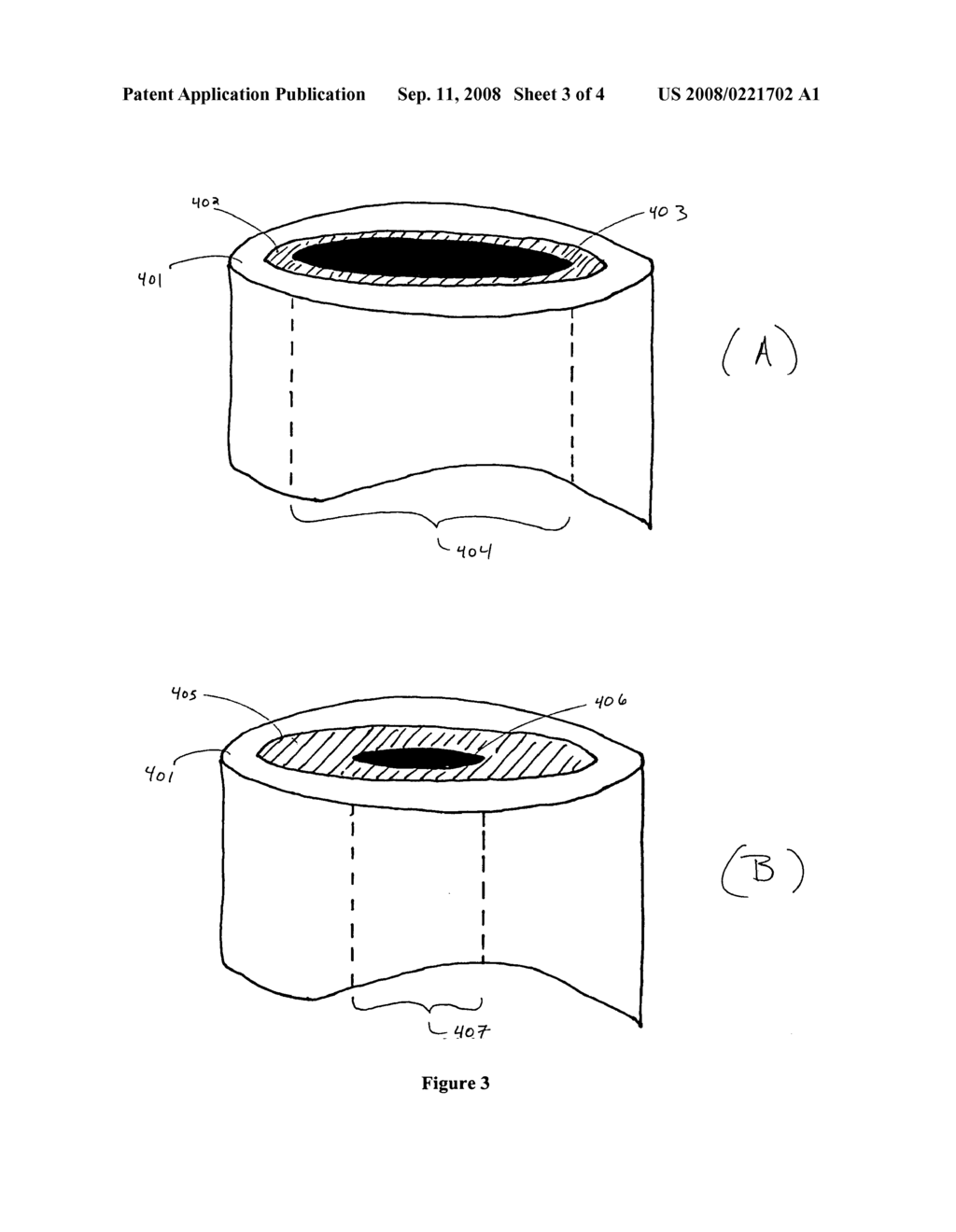 Methods and devices for intragastrointestinal prostheses - diagram, schematic, and image 04