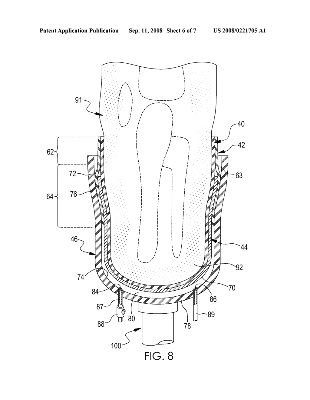VACUUM ASSISTED PROSTHETIC SLEEVE AND SOCKET - diagram, schematic, and image 07