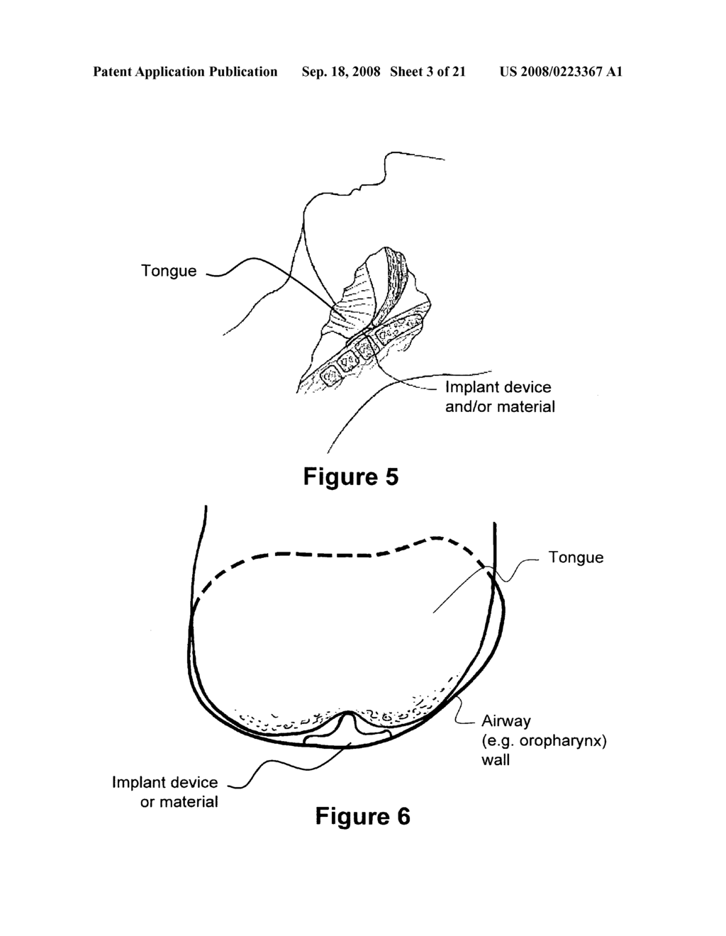 Method and apparatus for treating airway obstruction - diagram, schematic, and image 04
