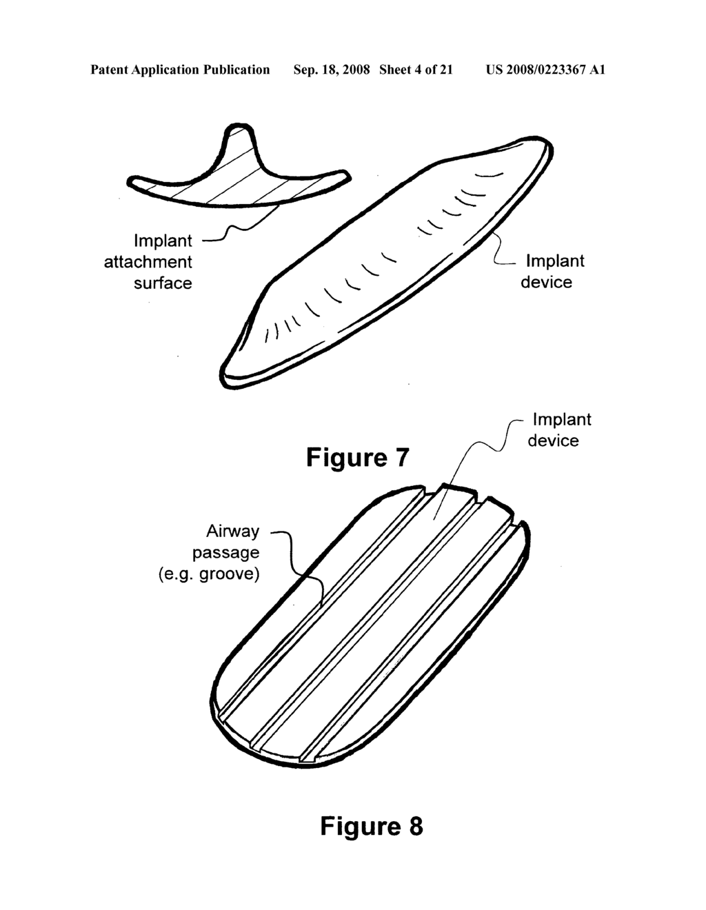 Method and apparatus for treating airway obstruction - diagram, schematic, and image 05