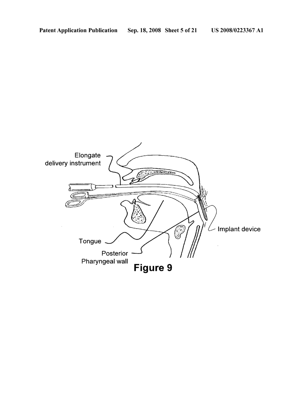 Method and apparatus for treating airway obstruction - diagram, schematic, and image 06