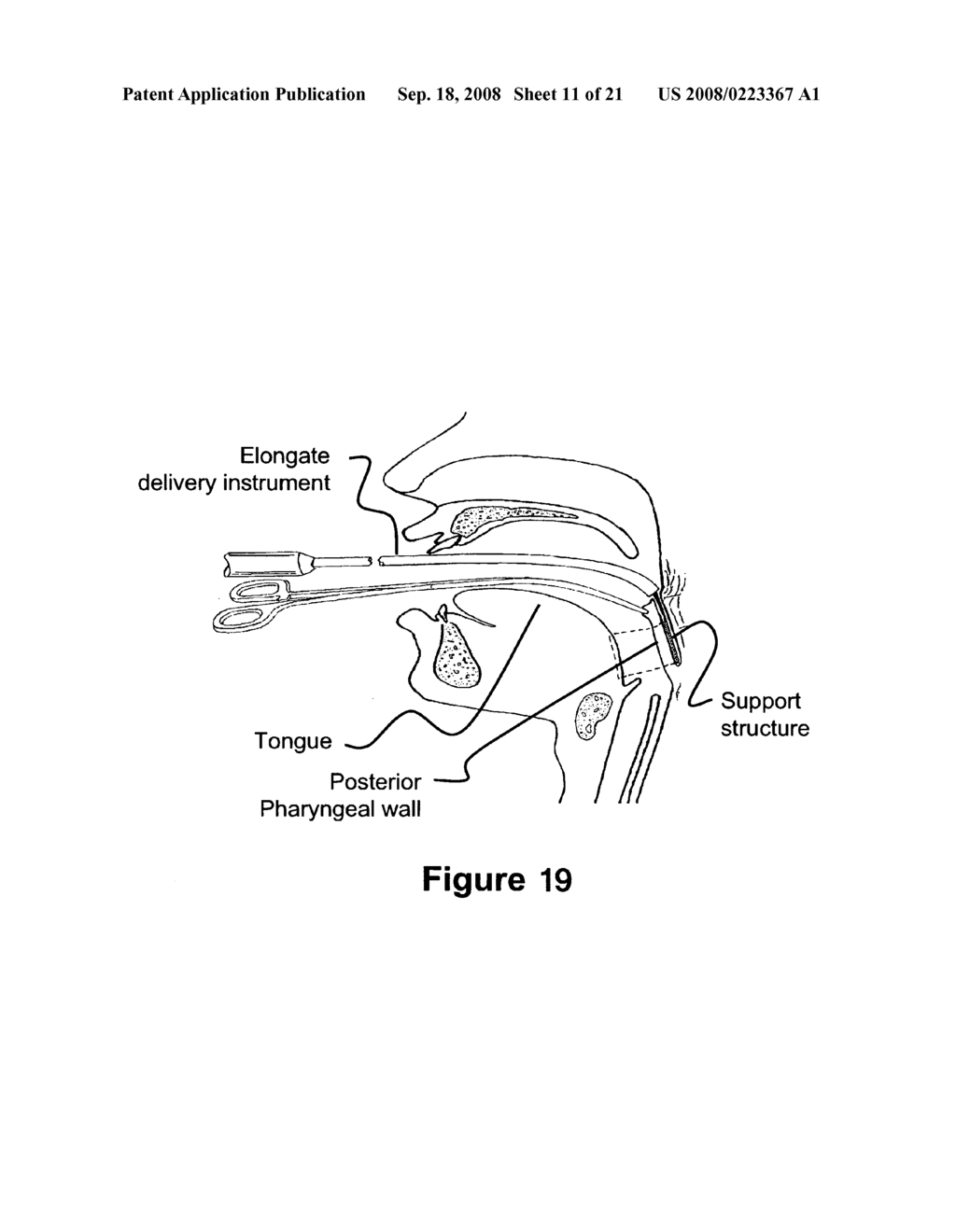 Method and apparatus for treating airway obstruction - diagram, schematic, and image 12