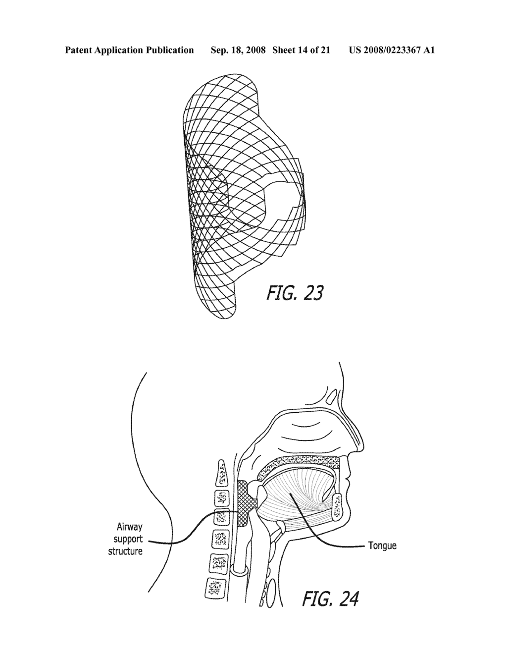 Method and apparatus for treating airway obstruction - diagram, schematic, and image 15