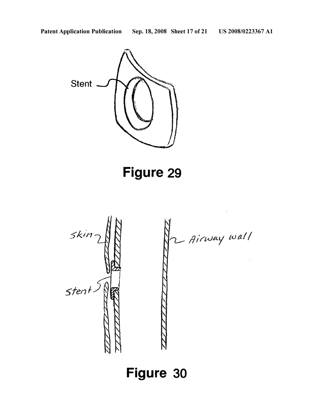 Method and apparatus for treating airway obstruction - diagram, schematic, and image 18