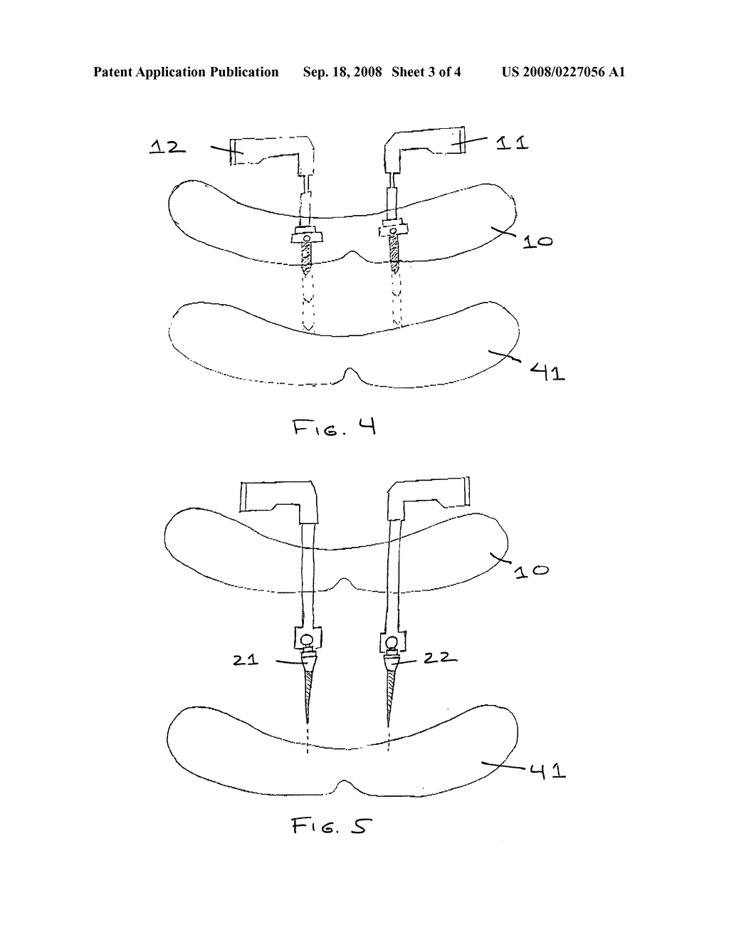 STENT FOR IMPLANT GUIDE AND PROSTHETICS - diagram, schematic, and image 04