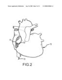 HIGH DENSITY MAPPING CATHETER diagram and image