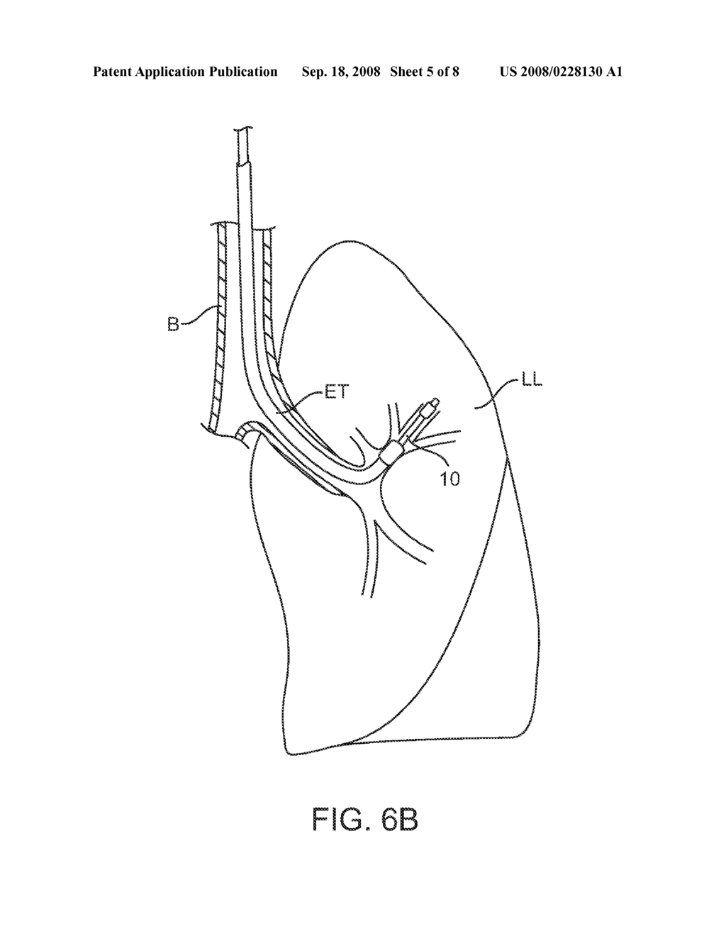 METHODS AND SYSTEMS FOR OCCLUDING COLLATERAL FLOW CHANNELS IN THE LUNG - diagram, schematic, and image 06