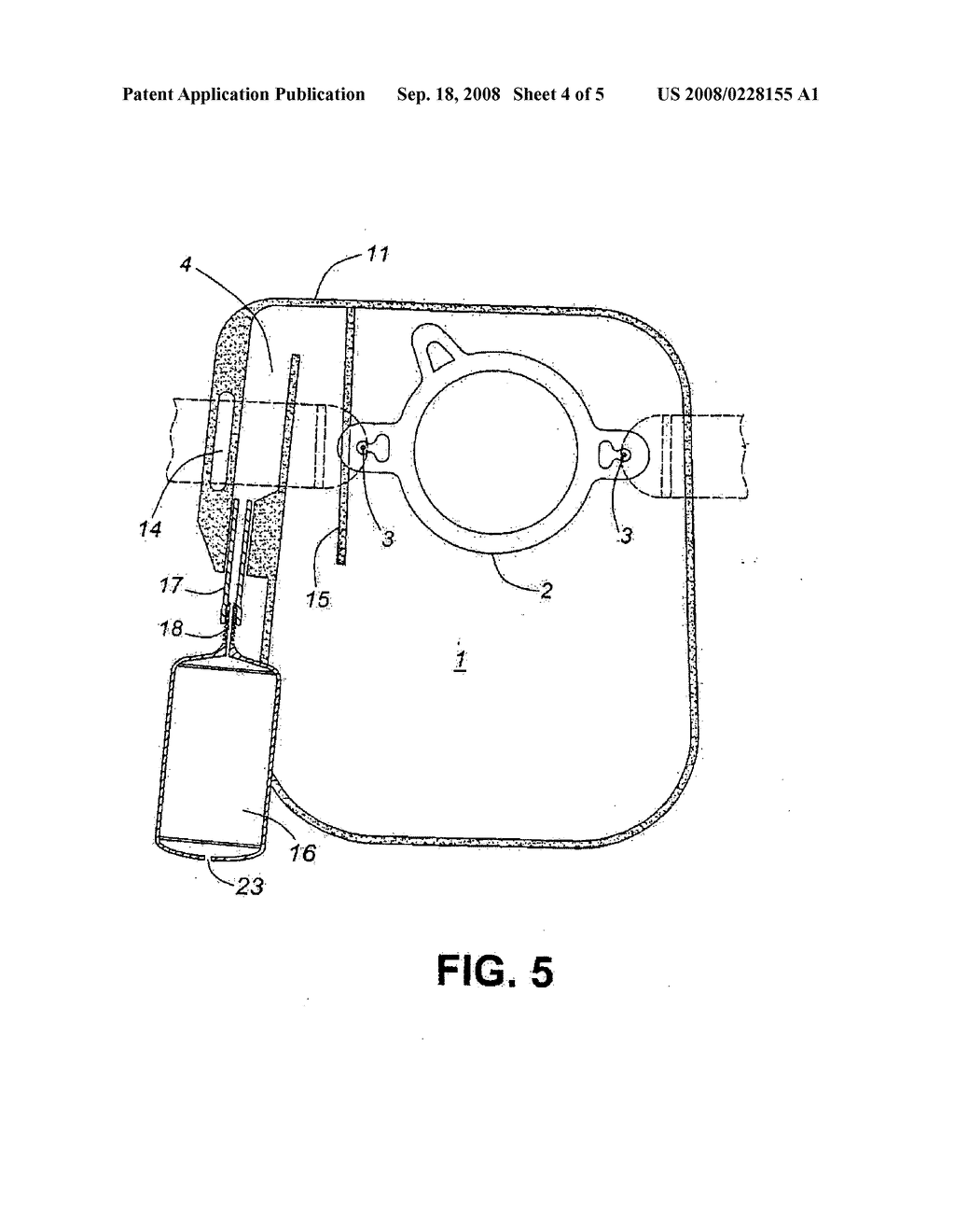 Colostomy bag - diagram, schematic, and image 05