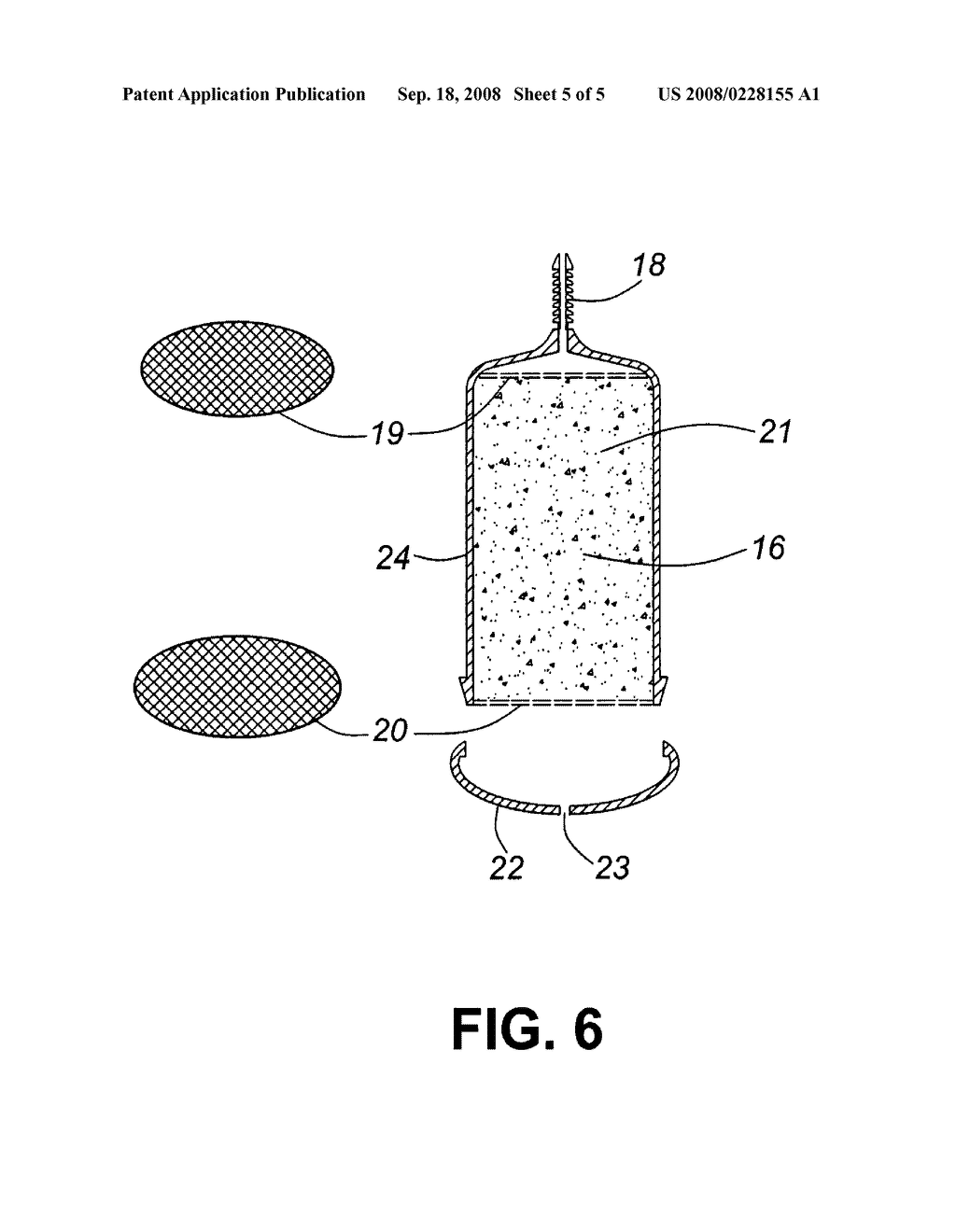 Colostomy bag - diagram, schematic, and image 06