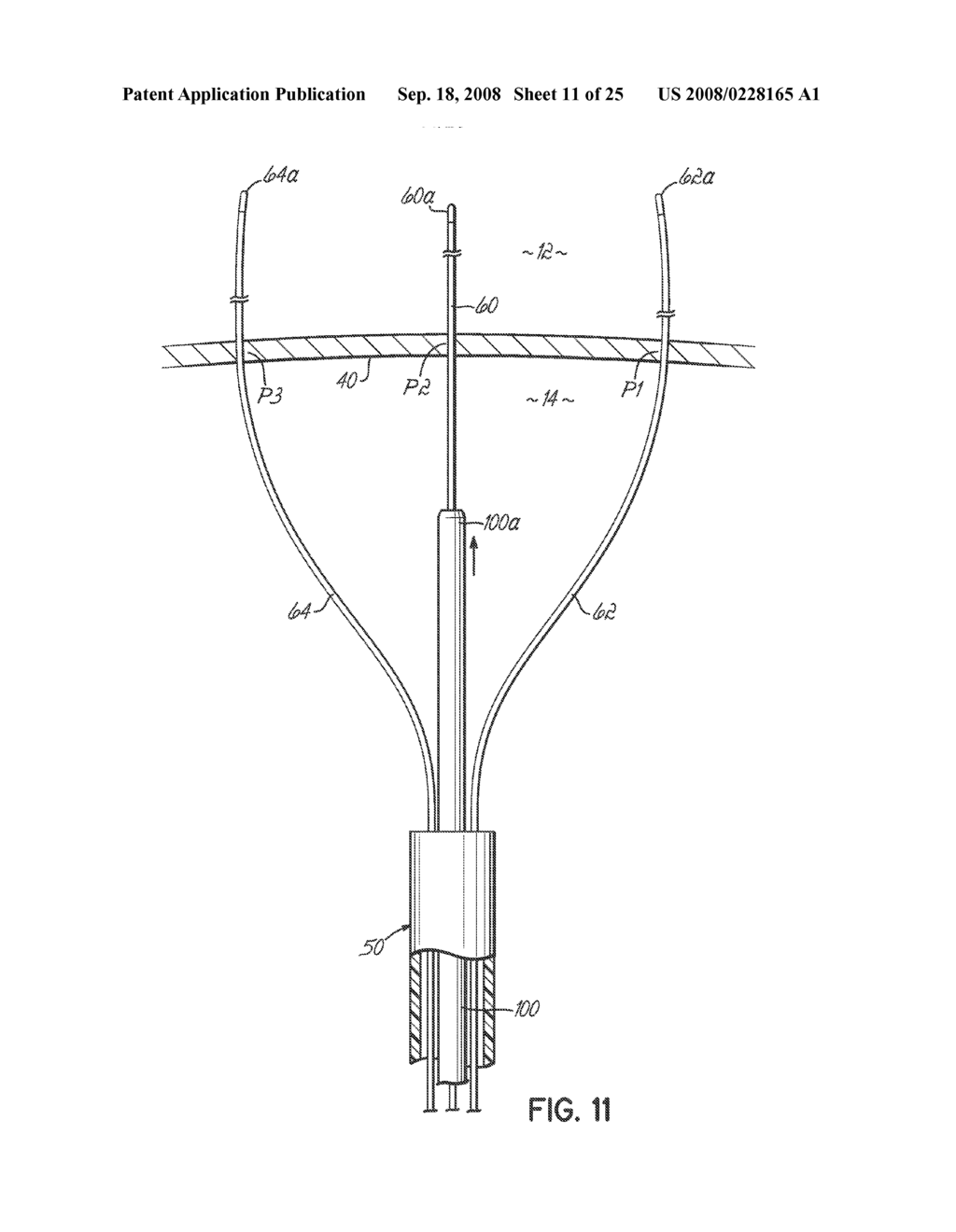 SYSTEMS AND METHODS FOR INTRODUCING ELEMENTS INTO TISSUE - diagram, schematic, and image 12