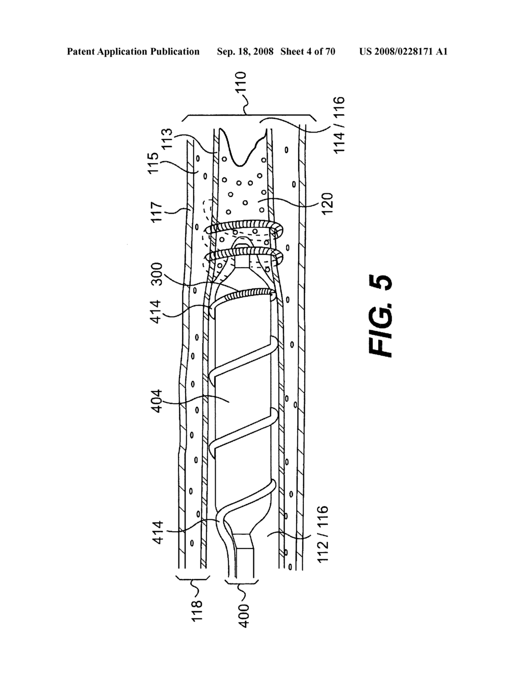 Endovascular devices and methods for exploiting intramural space - diagram, schematic, and image 05