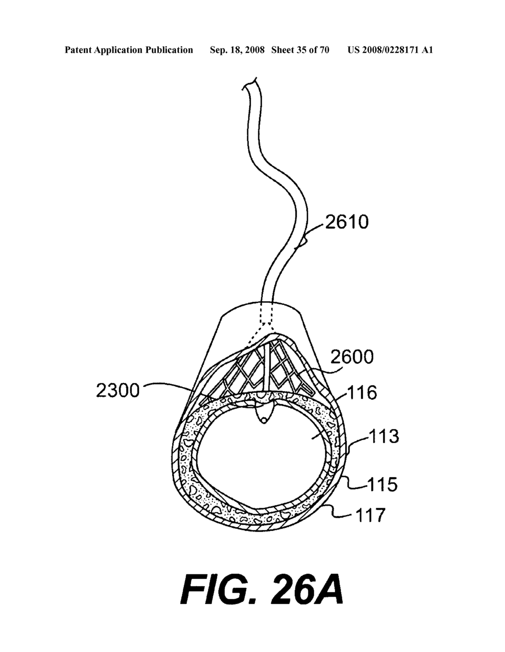 Endovascular devices and methods for exploiting intramural space - diagram, schematic, and image 36