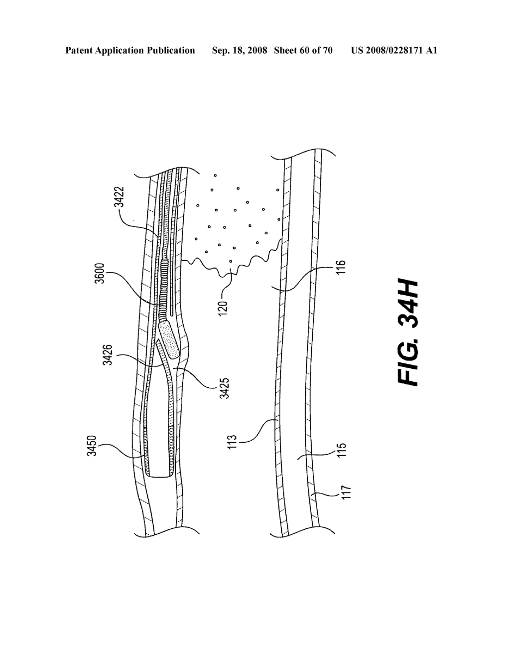 Endovascular devices and methods for exploiting intramural space - diagram, schematic, and image 61