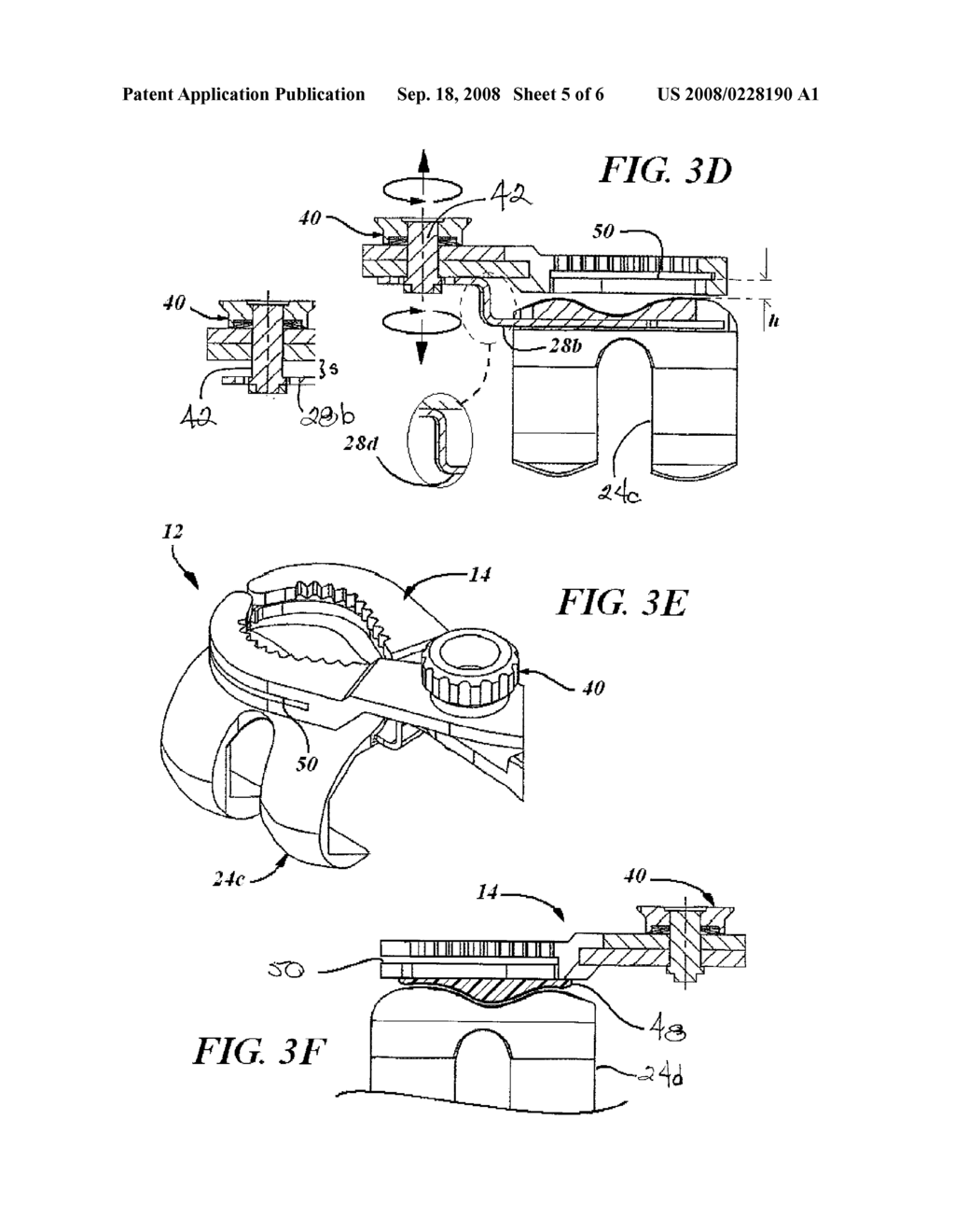 IN SITU PATELLAR FIXING SYSTEM - diagram, schematic, and image 06