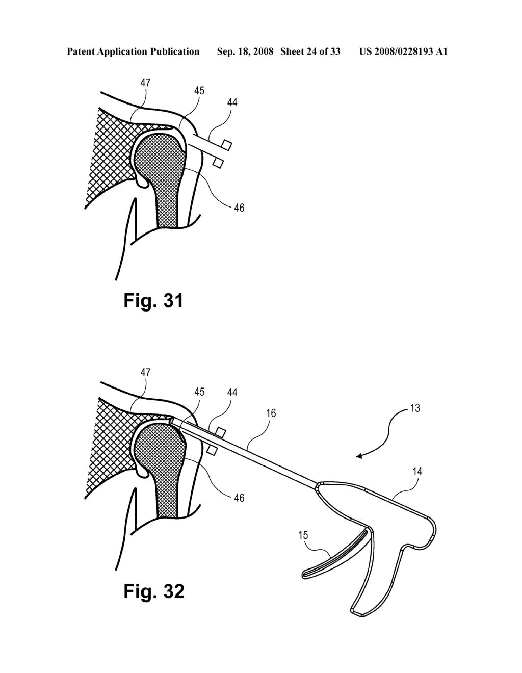 IMPLANTABLE MEDICAMENT DELIVERY DEVICE AND DELIVERY TOOL AND METHOD FOR USE THEREWITH - diagram, schematic, and image 25