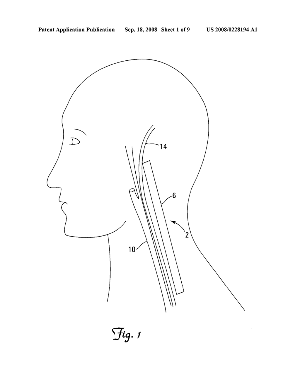 METHOD AND APPARATUS FOR ENDOSCOPIC ACCESS TO THE VAGUS NERVE - diagram, schematic, and image 02