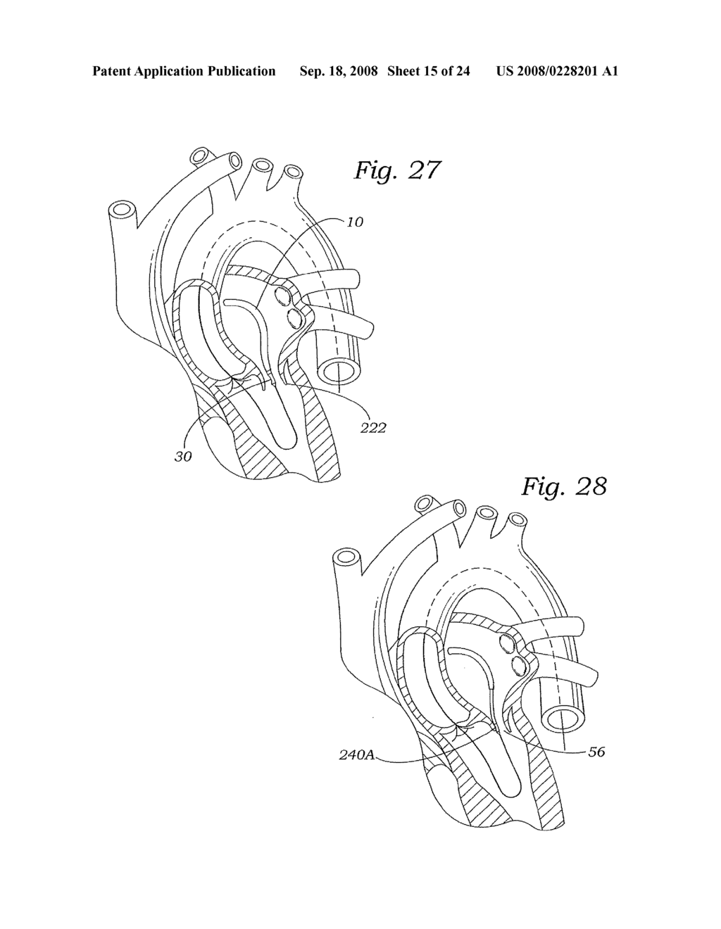 MITRAL VALVE REPAIR SYSTEM AND METHOD FOR USE - diagram, schematic, and image 16