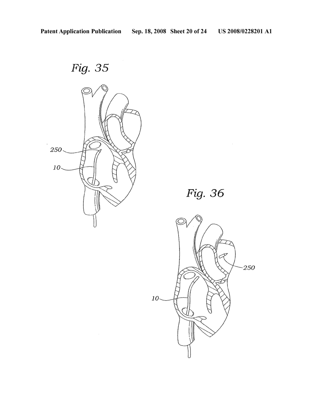 MITRAL VALVE REPAIR SYSTEM AND METHOD FOR USE - diagram, schematic, and image 21