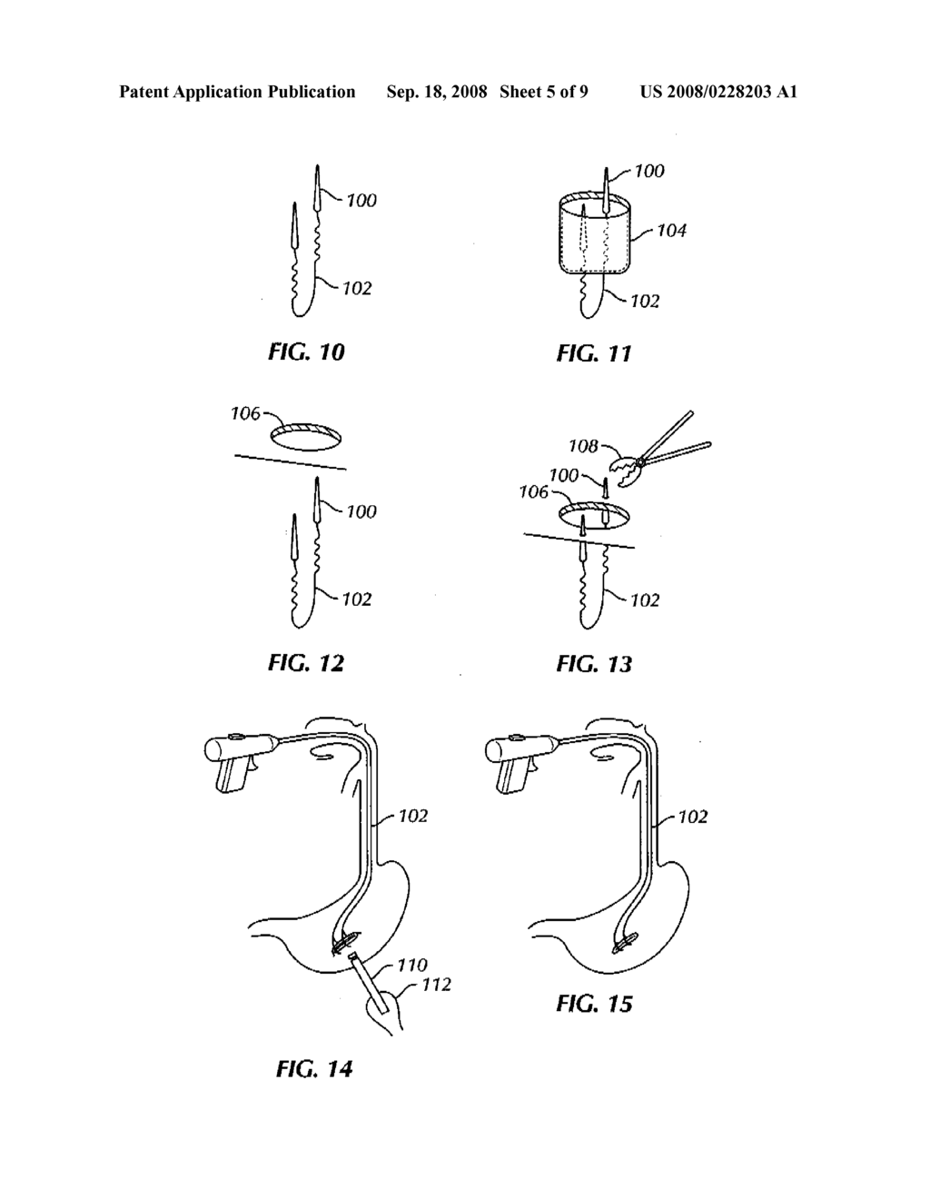 SYSTEM AND METHOD FOR TRANSLUMENAL CLOSURE IN NATURAL ORIFICE SURGERY - diagram, schematic, and image 06