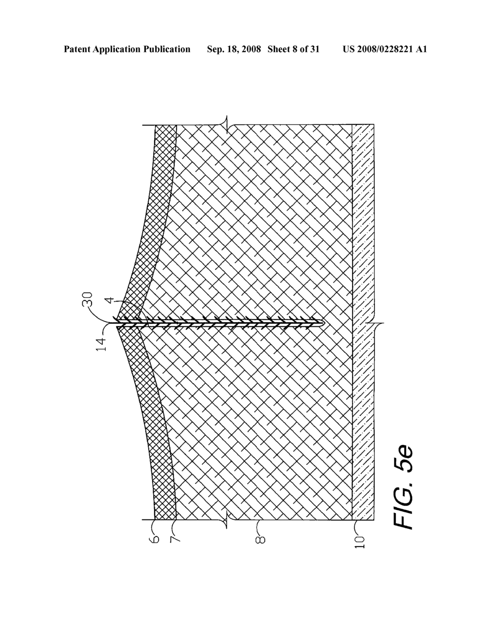 SCREEN DEVICES AND METHODS FOR CLOSING TISSUE SEPARATIONS - diagram, schematic, and image 09