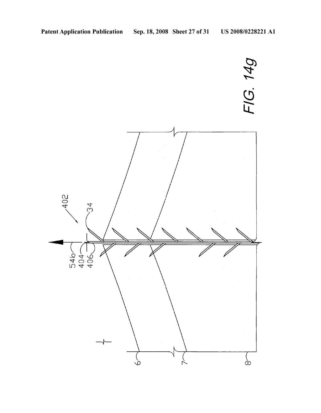 SCREEN DEVICES AND METHODS FOR CLOSING TISSUE SEPARATIONS - diagram, schematic, and image 28