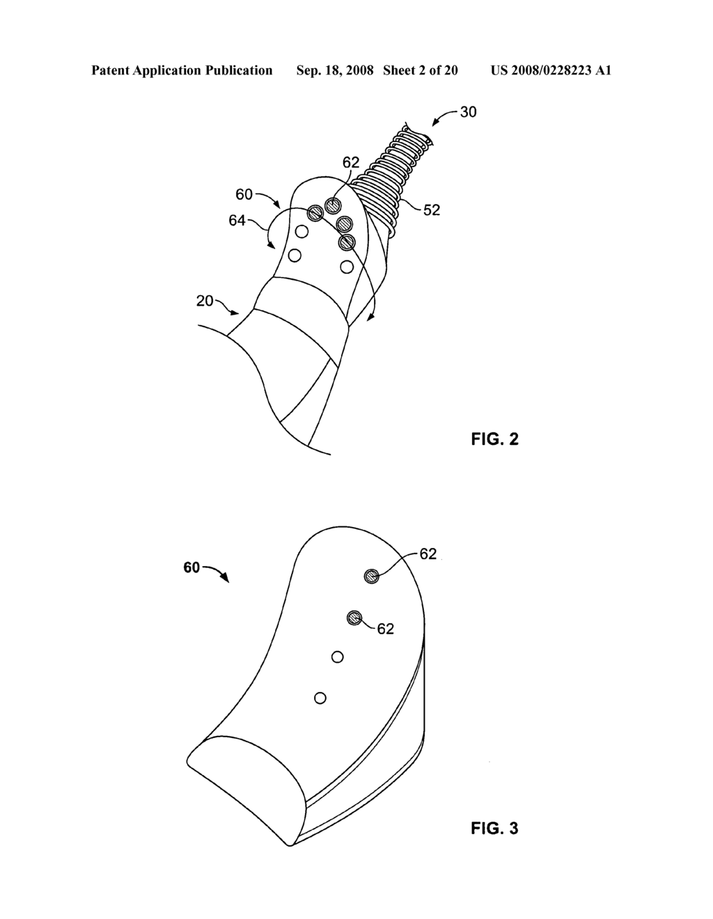 Heart valve chordae replacement methods and apparatus - diagram, schematic, and image 03