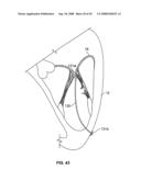 Heart valve chordae replacement methods and apparatus diagram and image