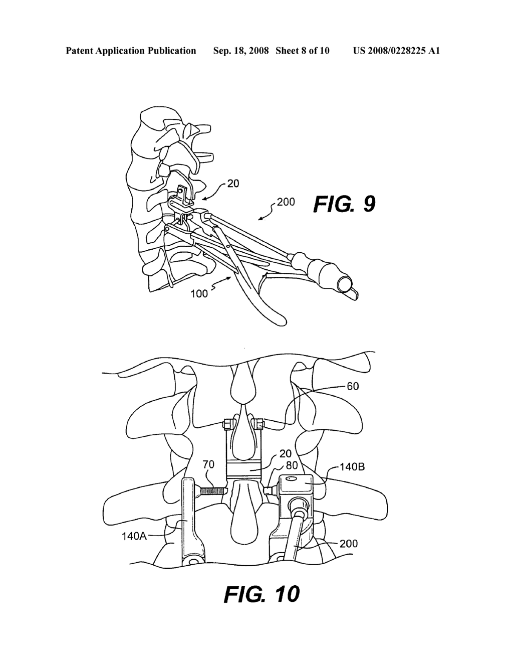 Interlaminar-Interspinous Vertebral Stabilization System - diagram, schematic, and image 09