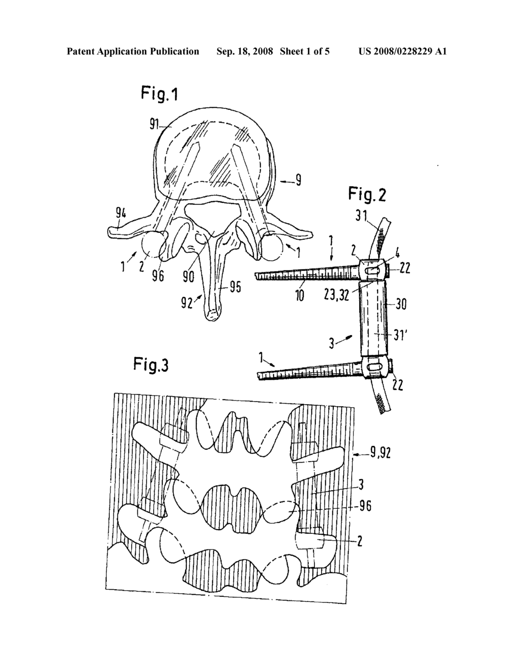 PEDICLE SCREW FOR INTERVERTEBRAL SUPPORT ELEMENTS - diagram, schematic, and image 02