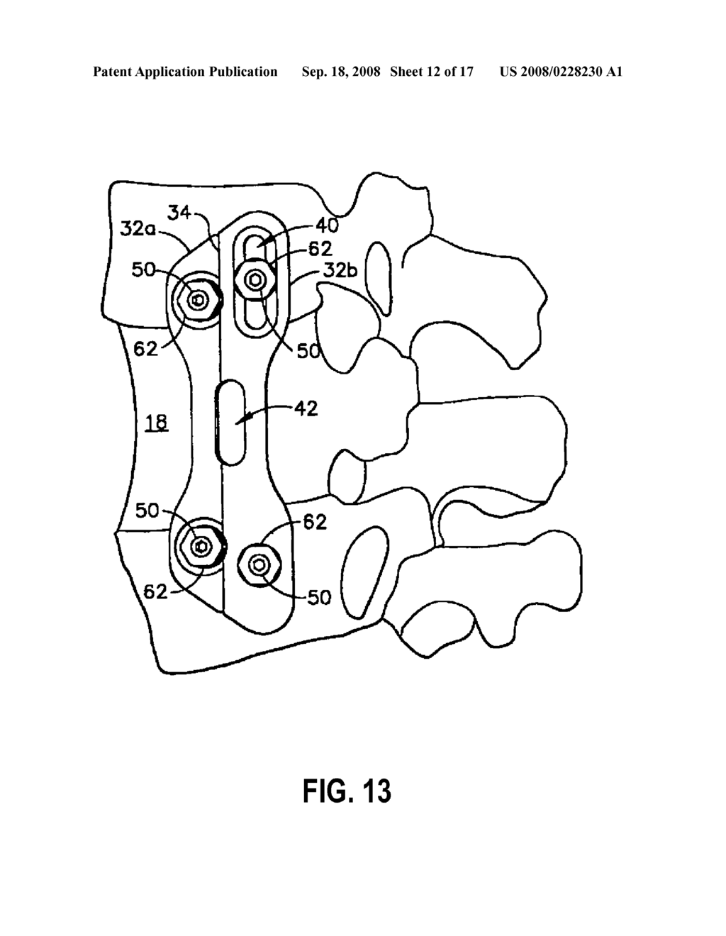 Hinged Bone Plate and Related Methods - diagram, schematic, and image 13