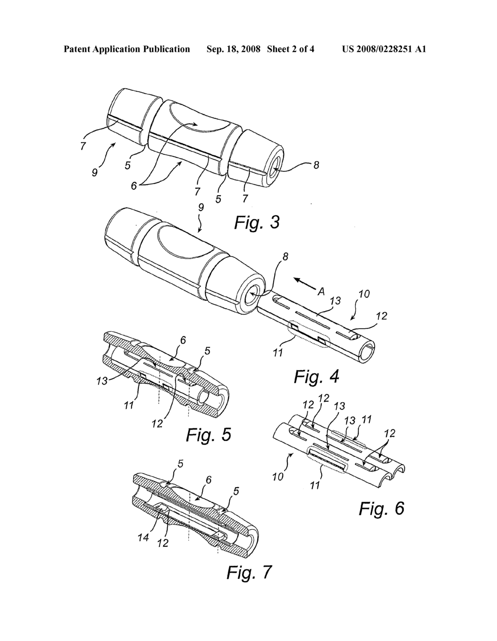 Suture Sleeve - diagram, schematic, and image 03