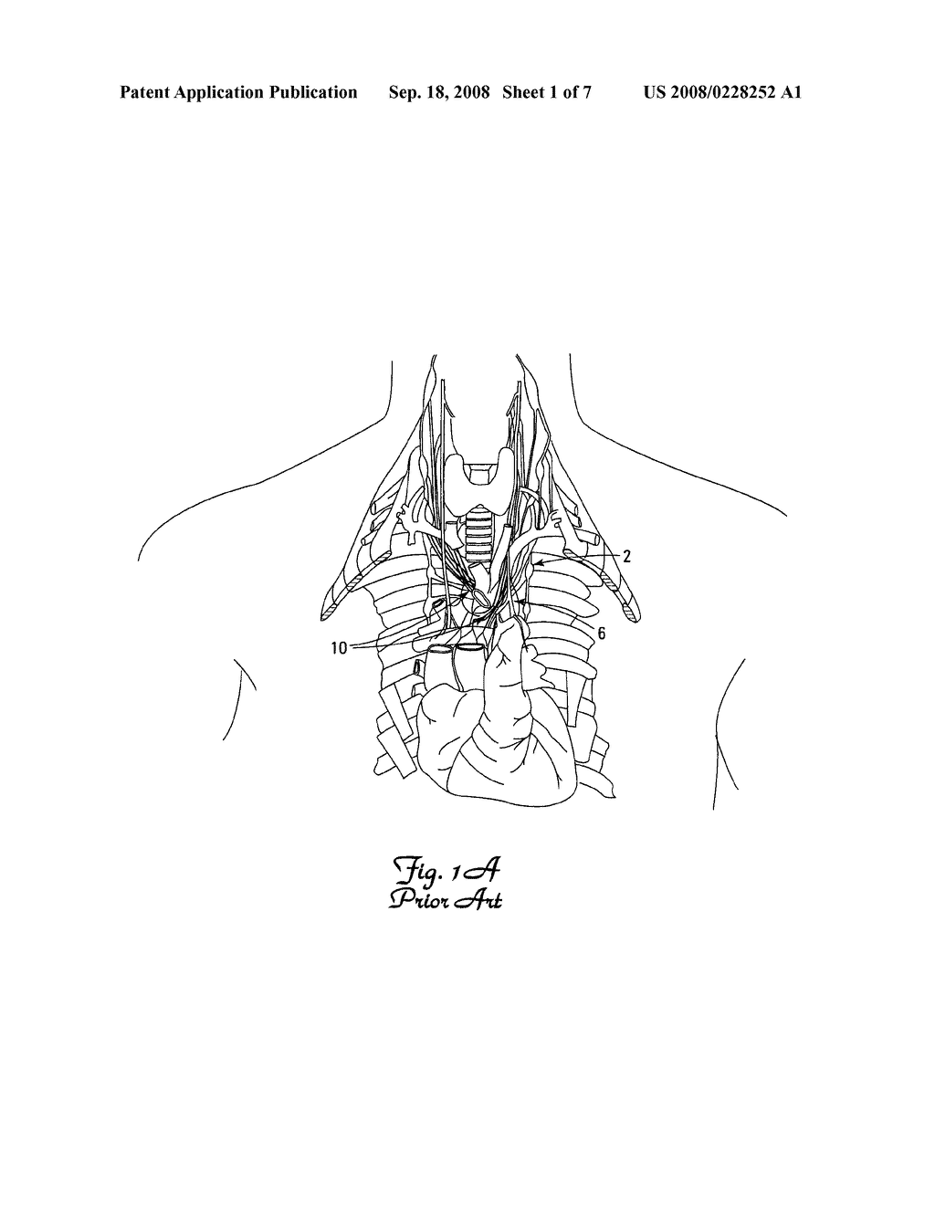 LEAD AND APPARATUS FOR STIMULATION OF THE CARDIAC PLEXUS - diagram, schematic, and image 02