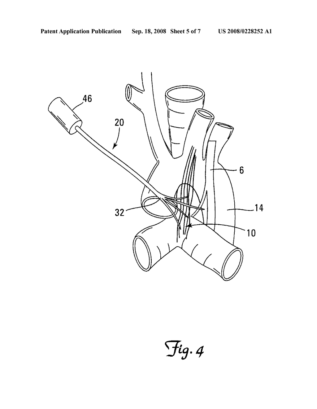 LEAD AND APPARATUS FOR STIMULATION OF THE CARDIAC PLEXUS - diagram, schematic, and image 06