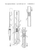 Intravascular stent with integrated link and ring strut diagram and image