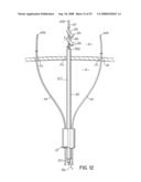 DEVICES AND METHODS FOR INTRODUCING ELEMENTS INTO TISSUE diagram and image