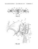 DEVICES AND METHODS FOR INTRODUCING ELEMENTS INTO TISSUE diagram and image