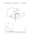 Intubation guide diagram and image